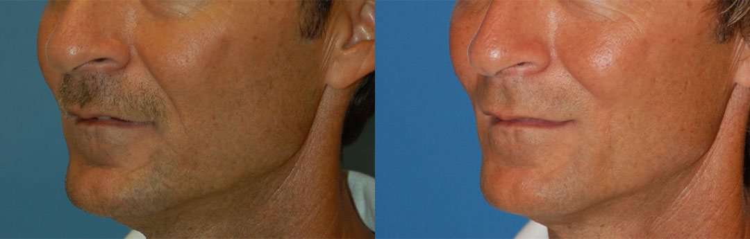 Nasolabial Folds Photos Melbourne Fl Patient 217